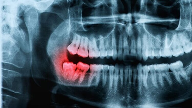 Are Wisdom Teeth Extractions Always Necessary?