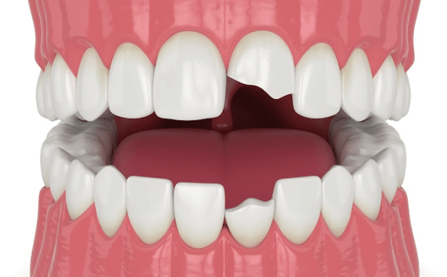 chipped teeth treatment croydon