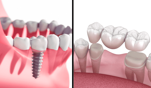 dental implants and crowns croydon